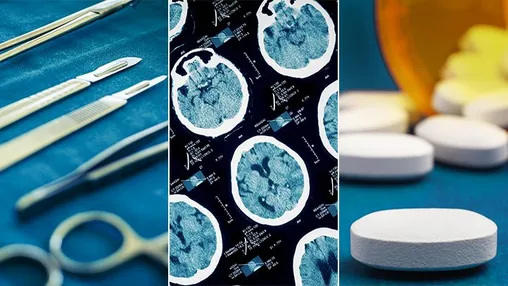 What’s the Best Treatment for an Aneurysm?