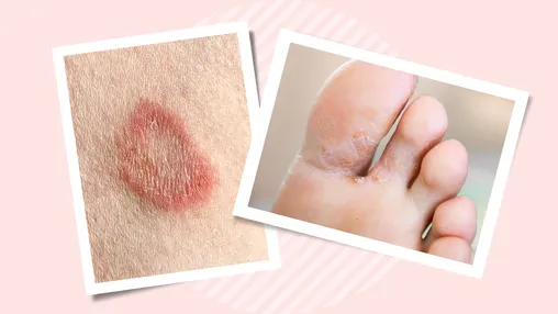 What Are Fungal Skin Infections?