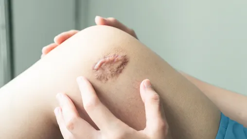 What Is a Keloid? Symptoms, Causes, Diagnosis, Treatment, and Prevention