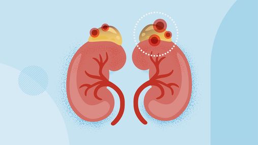 What Is Adrenal Carcinoma?