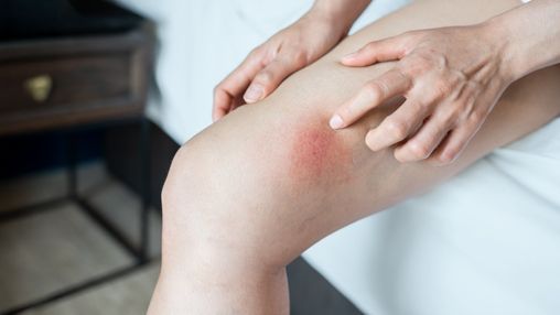 What Is Chafing?