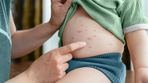 What Is Cutaneous Mastocytosis?