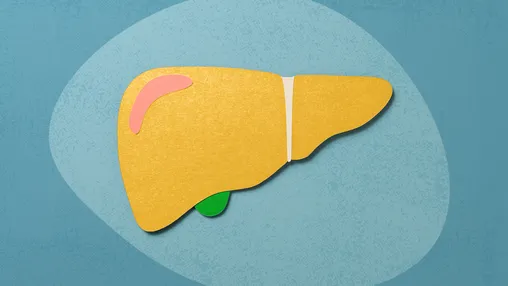 What Is Metabolic Dysfunction–Associated Steatotic Liver Disease?