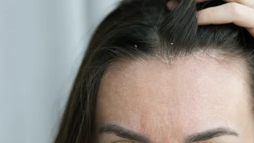 What Is Seborrheic Dermatitis?